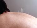 Barbican Acupuncture for Pain Relief, Sports Injury: London, EC2 image 4