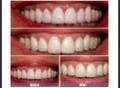 Teeth whitening london cosmetic dentist invisalign braces laser zoom veneers image 5
