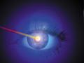 Laser Eye Surgery Treatments image 1