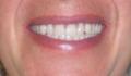 Cosmetic Denture Design, Teeth Whitening and Fangs by Speedy Denture Repairs LTD logo