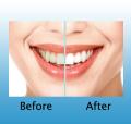 Teeth whitening london cosmetic dentist invisalign braces laser zoom veneers image 3