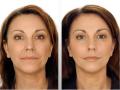 DermaDoc (London) - BOTOX / LIP FILLERS / PEELS image 4