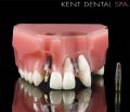 Dentist Kent Dental Spa - Cosmetic Dentist & Dental implants Bromley image 9