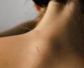 Barbican Acupuncture for Pain Relief, Sports Injury: London, EC2 image 3
