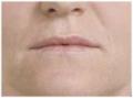 Botox and Dermal Fillers wrinkle removal at Kingswood Clinic in Blackburn image 5