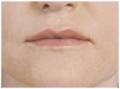 Botox and Dermal Fillers wrinkle removal at Kingswood Clinic in Blackburn image 4
