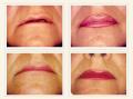 DermaDoc (London) - BOTOX / LIP FILLERS / PEELS image 3