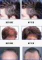 Hair Loss Treatment London image 2