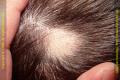 Alopecia Clinic image 1